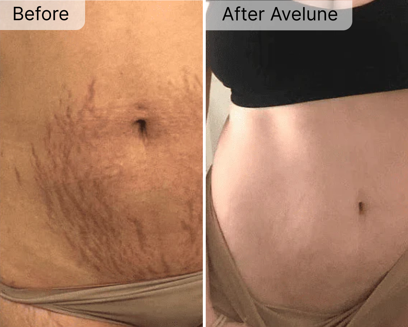 Avelune Micro-Infusion System