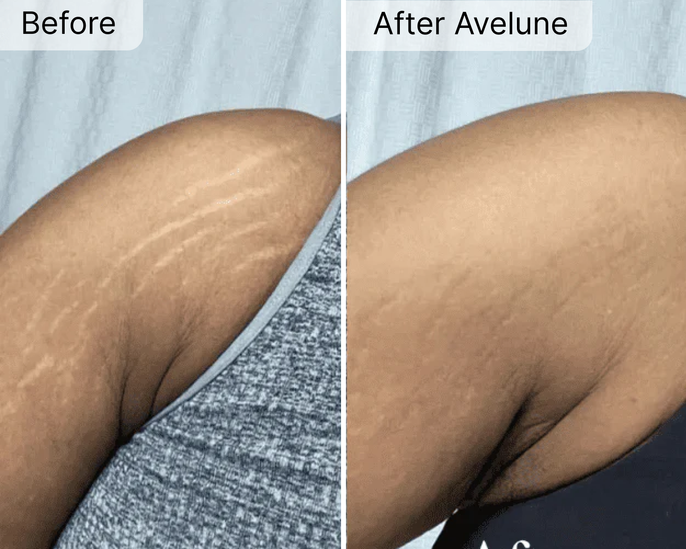 Avelune Micro-Infusion System