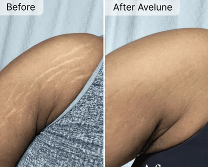 Avelune Micro-Infusion System
