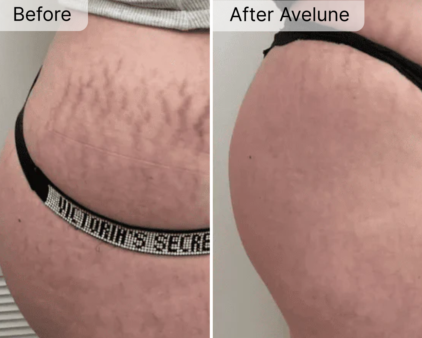 Avelune Micro-Infusion System