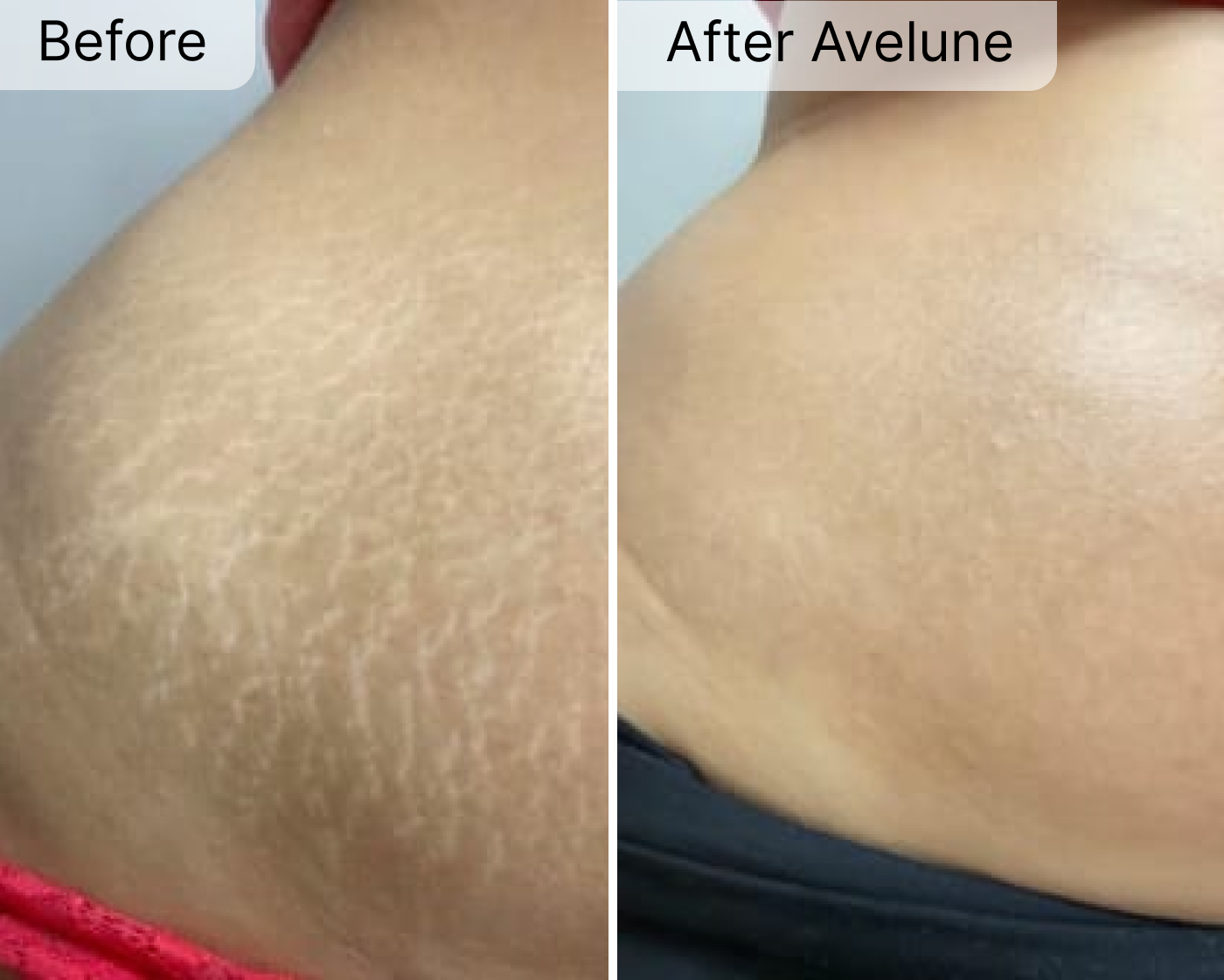 Avelune Micro-Infusion System